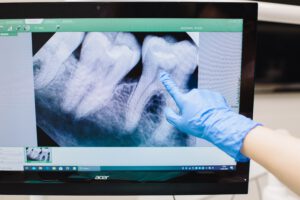 Endodontie Close-up of a dental X-ray displayed on a monitor with a gloved hand pointing.